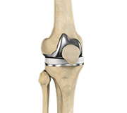 Accelerated Recovery after Total Knee Replacement