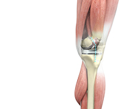 Outpatient Knee Replacement